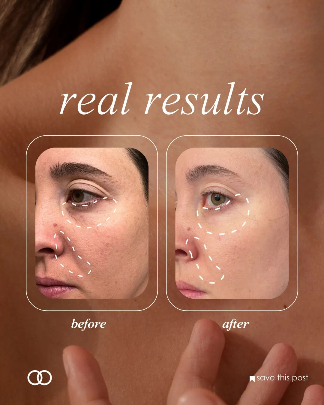 Phác đồ kết hợp Retinol và Repair Ampoule của SRX